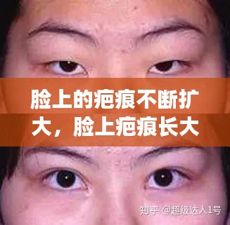 臉上的疤痕不斷擴(kuò)大，臉上疤痕長(zhǎng)大能變淡嗎 