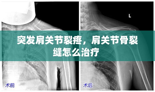 突發(fā)肩關節(jié)裂疼，肩關節(jié)骨裂縫怎么治療 