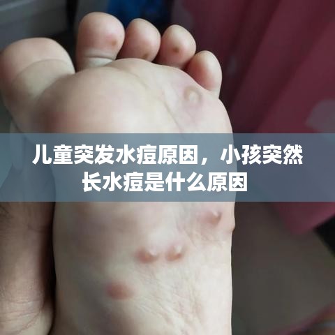 兒童突發(fā)水痘原因，小孩突然長水痘是什么原因 