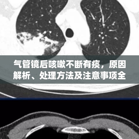 氣管鏡后咳嗽不斷有痰，原因解析、處理方法及注意事項(xiàng)全攻略