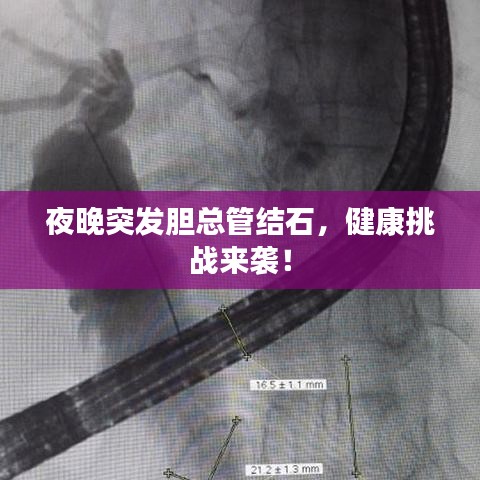 夜晚突發(fā)膽總管結(jié)石，健康挑戰(zhàn)來(lái)襲！